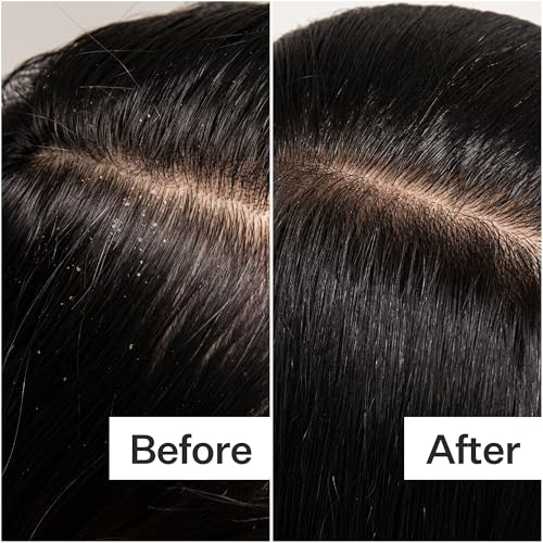 ACT+ ACRE Cold Processed Scalp Detox Oil - Sulfate-Free Care for Flaky, Dry and Itchy Scalp - Promotes Thicker, Fuller-Looking Hair